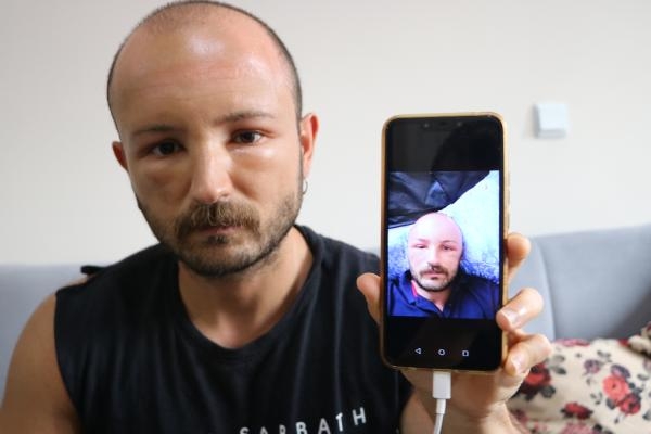 2 gün plaja gitti, başında nadir görülen sıcak ödemi oluştu 