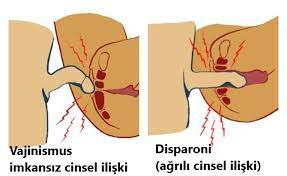 Vajinismus nedir?