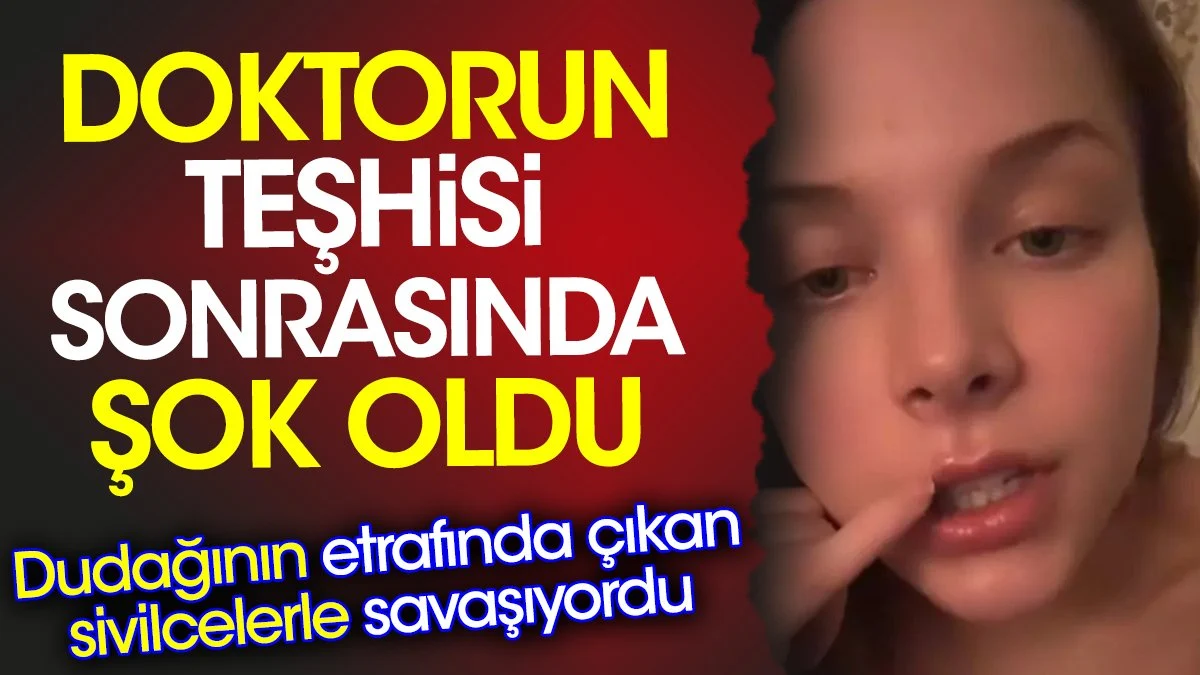 Doktorun teşhisi sonrasında şok oldu. Dudağının etrafında çıkan sivilcelerle savaşıyordu