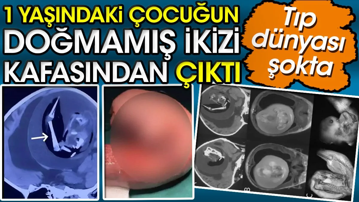 Tıp dünyası şokta! 1 yaşındaki çocuğun doğmamış ikizi kafasından çıktı