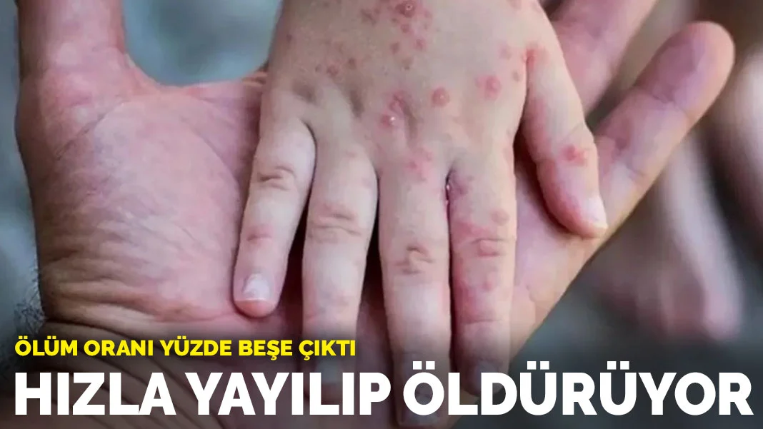 Uzmanından ölüm oranı yüzde beşe çıktı uyarısı: Maymun çiçeği hızla yayılıp öldürüyor
