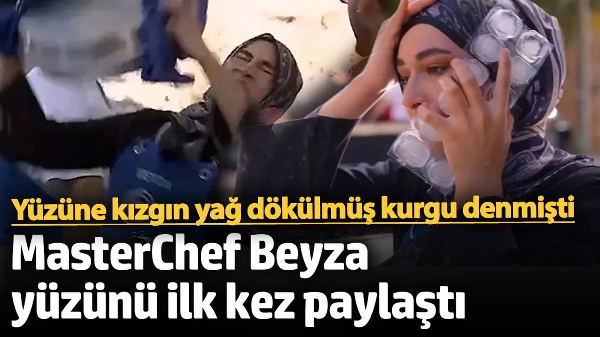 Yüzüne kızgın yağ dökülmüş, kurgu denmişti! MasterChef Beyza yüzünü ilk kez paylaştı