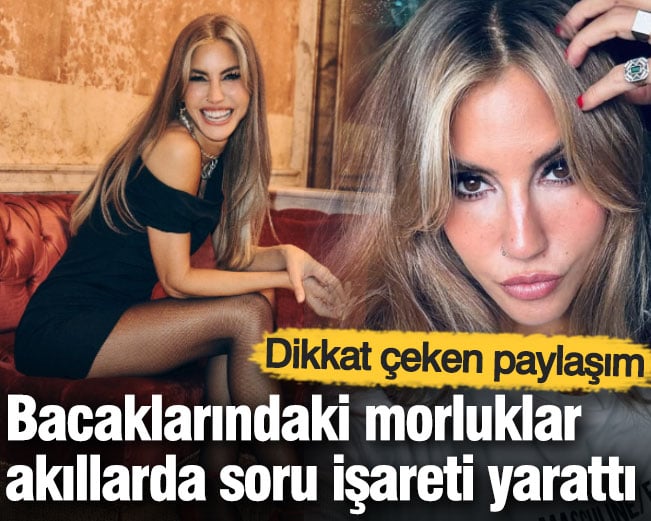 Çağla Şıkel’den dikkat çeken paylaşım: Bacaklarındaki morluklar akıllarda soru işareti yarattı